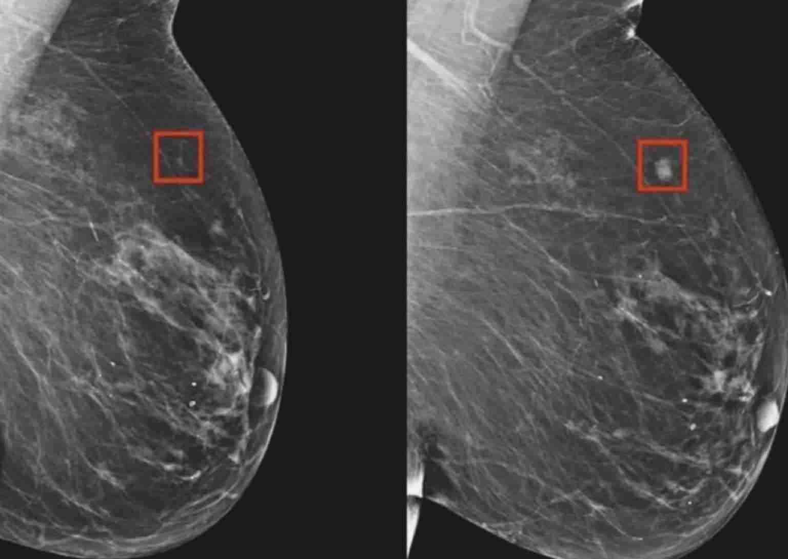 MIT Researchers Develop AI Model for Early Breast Cancer