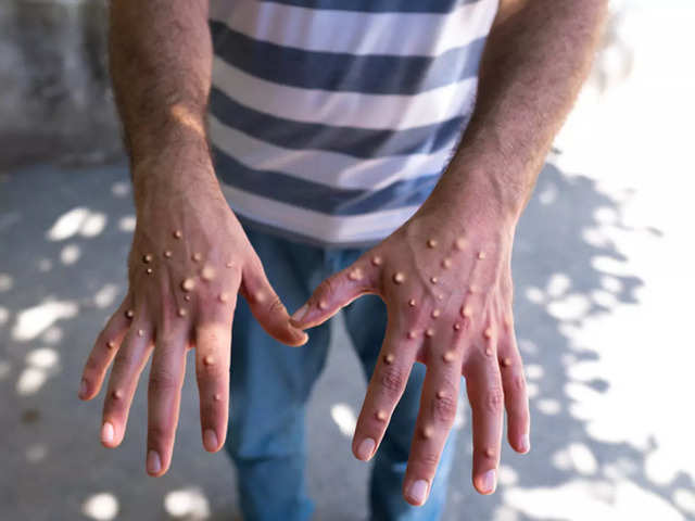 Mpox Declared Health Emergency in Africa: Causes,