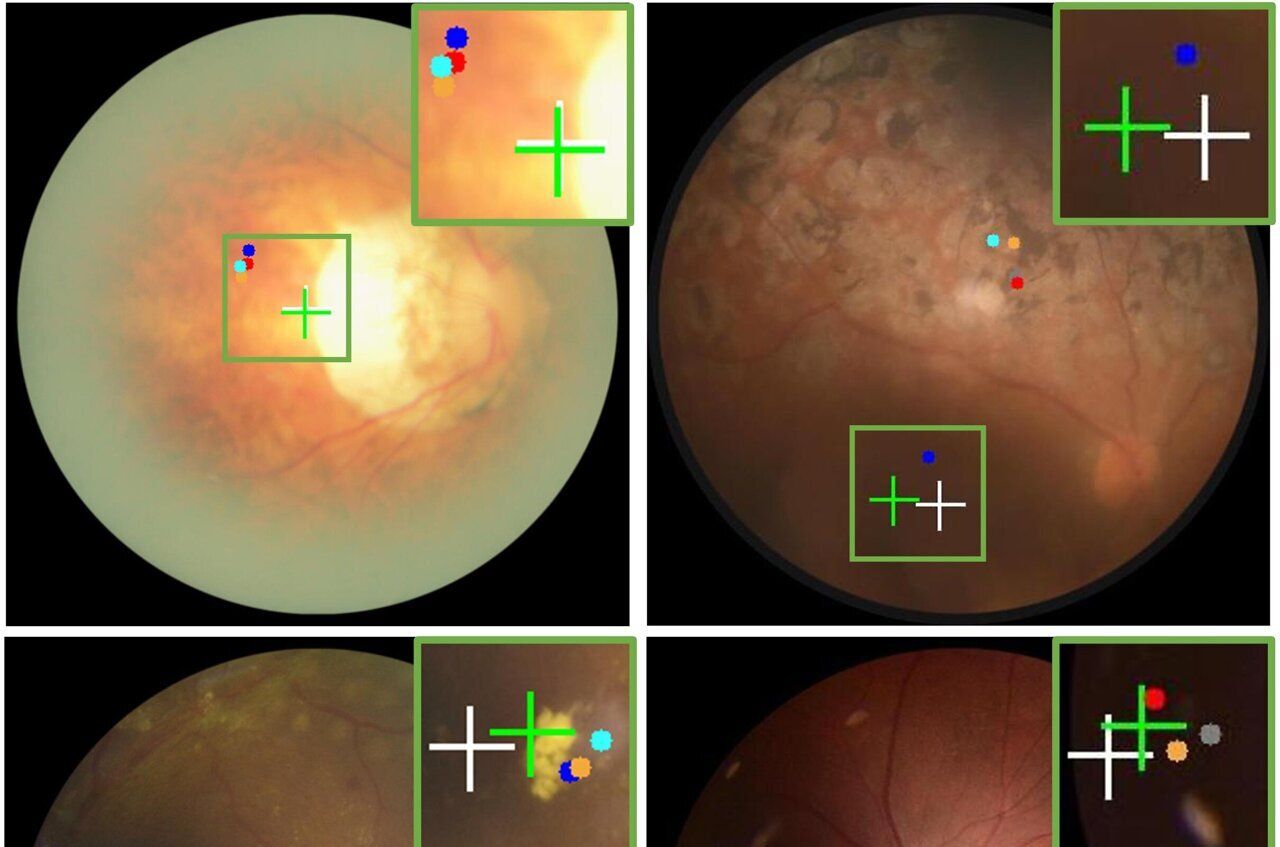 AI-Powered Imaging Technique Revolutionizes Retinal