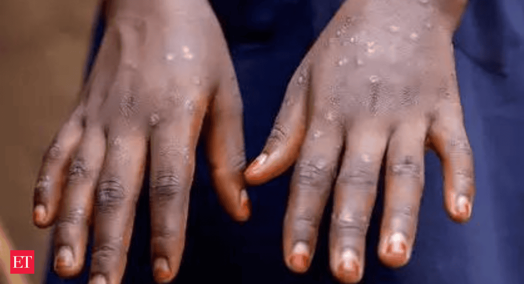 India Reports First Case of Mpox Clade 1 in Kerala: