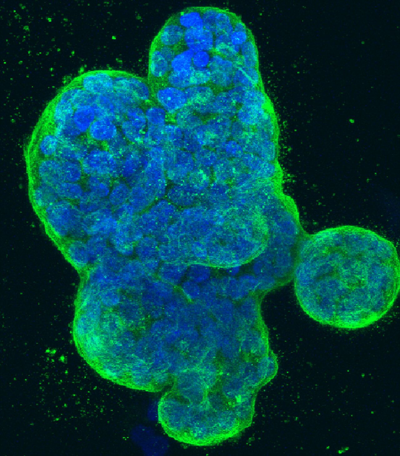 AI Breakthrough: Enhanced Breast Cancer Detection Using