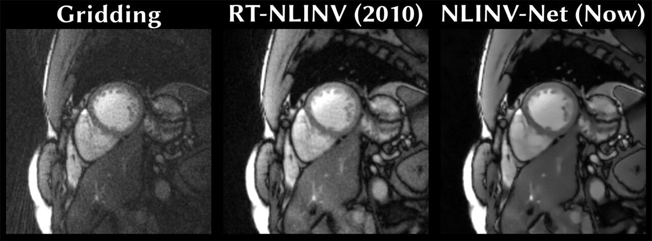 Revolutionary Machine Learning Method Enhances MRI Imaging