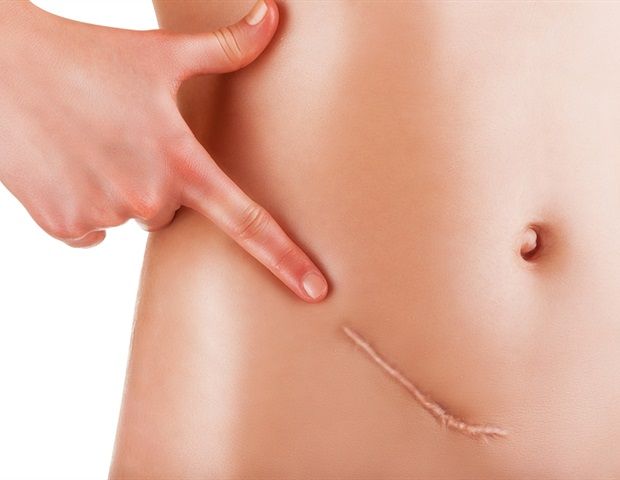 AI-Powered Blood Test Shows Promise for Early Ovarian