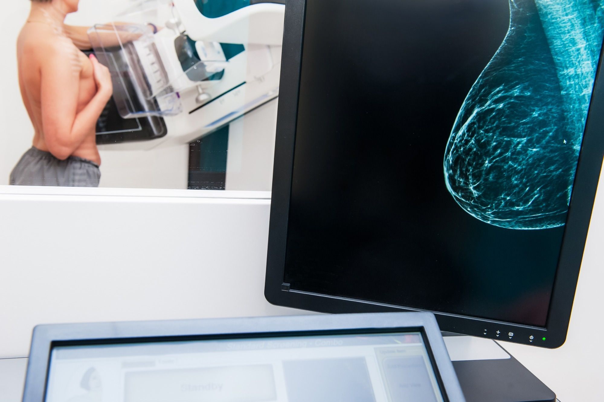 AI Algorithm Shows Promise in Early Detection of Breast