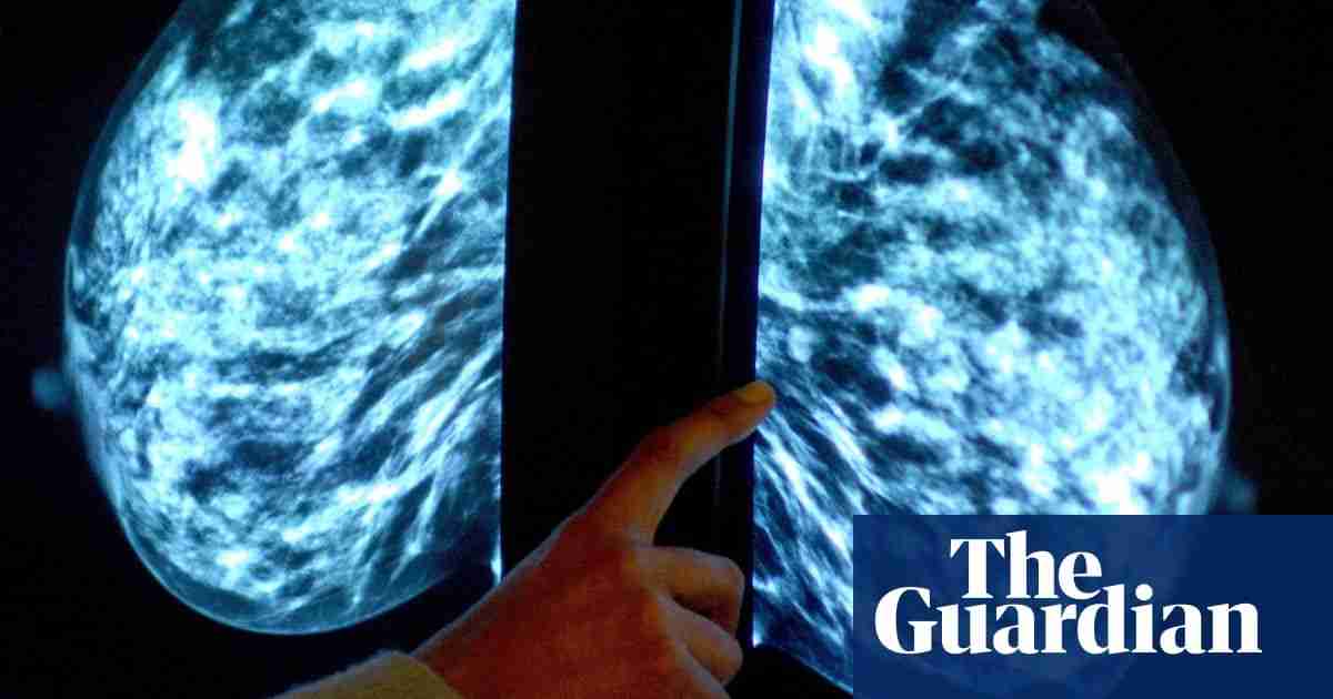 AI Boosts Breast Cancer Detection in Large-Scale German Study