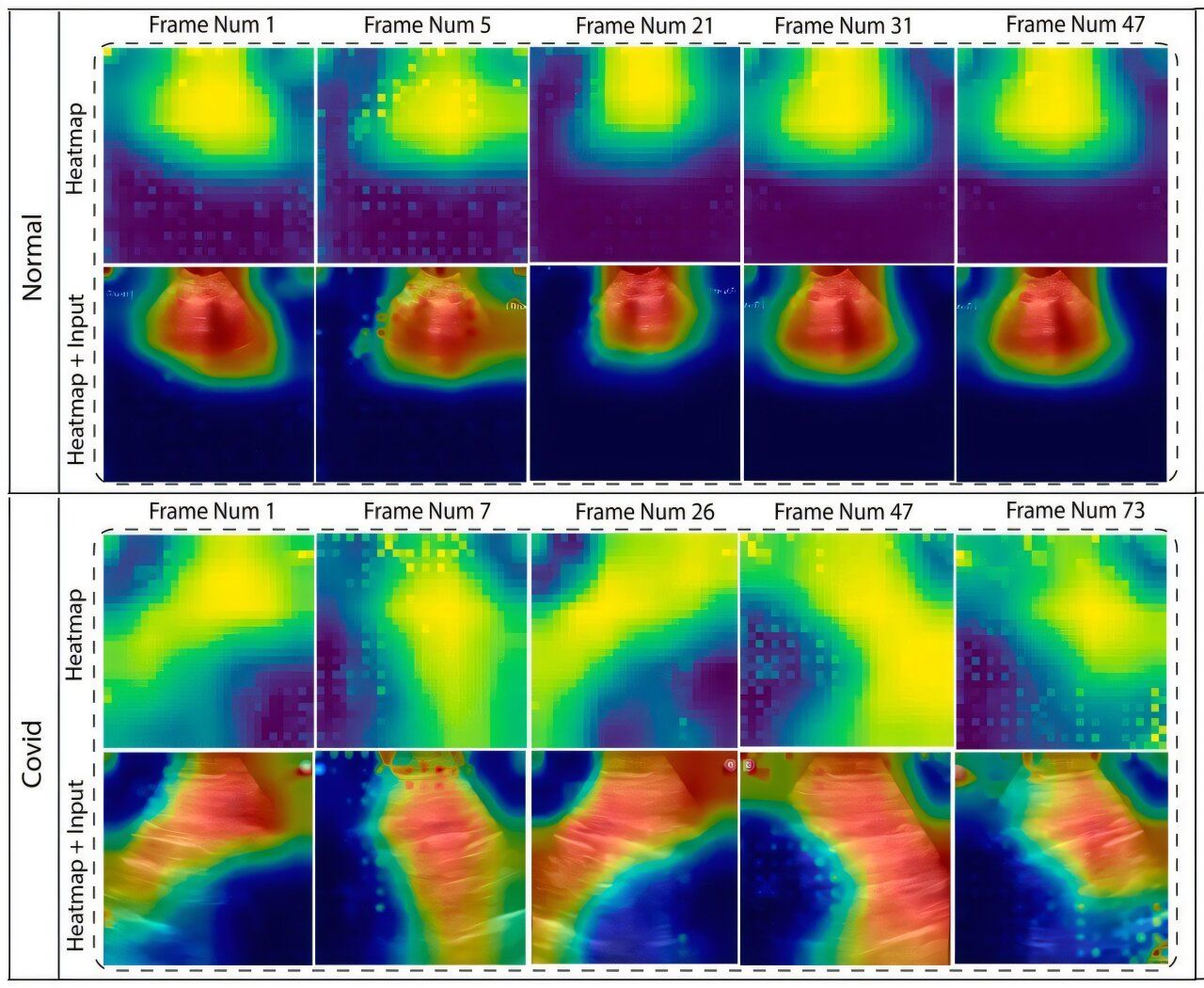 AI Breakthrough: 97% Accuracy in Lung Disease Detection and 