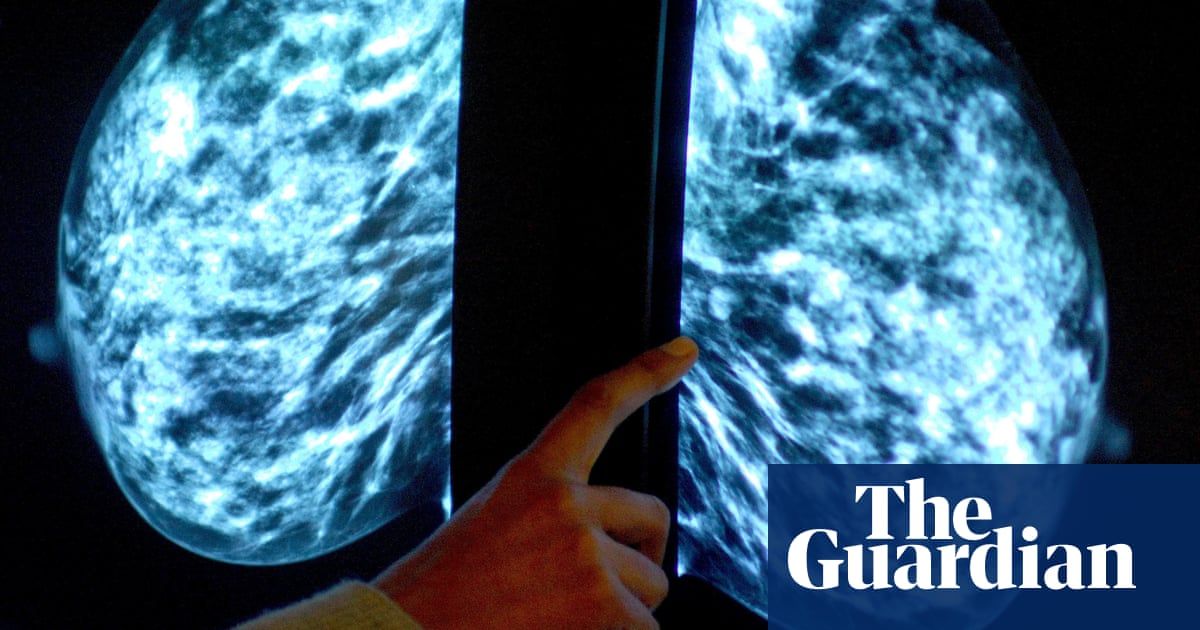 UK Launches World's Largest AI Trial for Breast Cancer