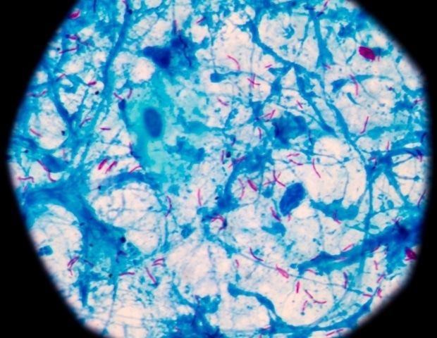 AI Breakthrough Accelerates Discovery of New Tuberculosis