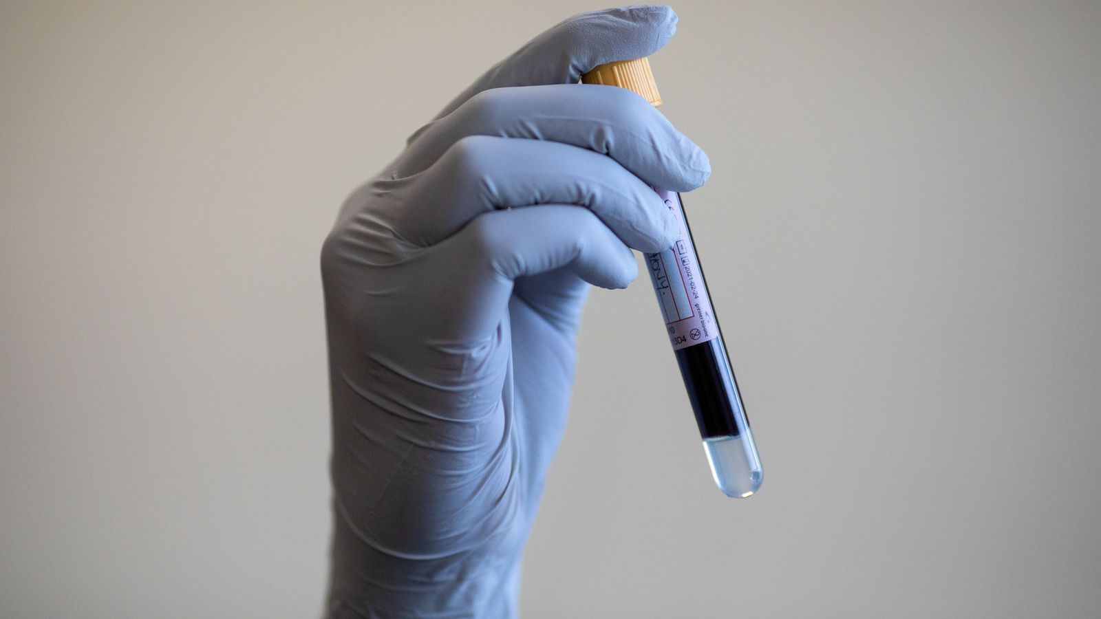 AI-Powered Blood Test for Early Cancer Detection to be