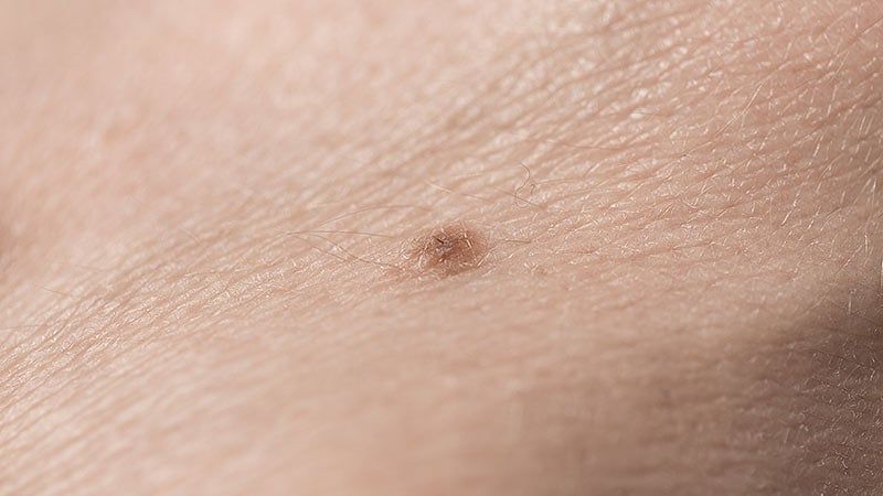 AI Tool for Skin Cancer Triage Receives Conditional NHS