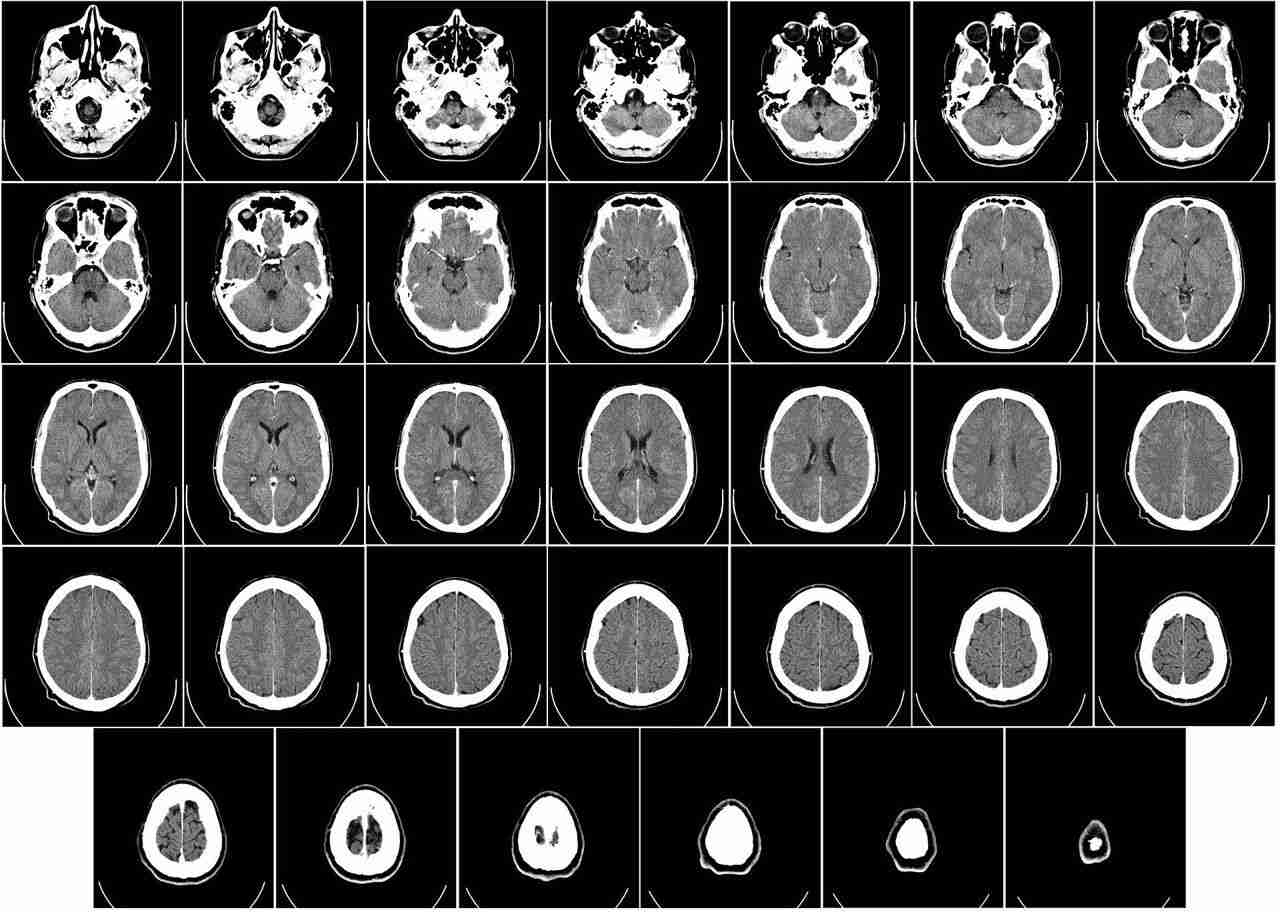 AI Model FastGlioma Revolutionizes Brain Tumor Detection