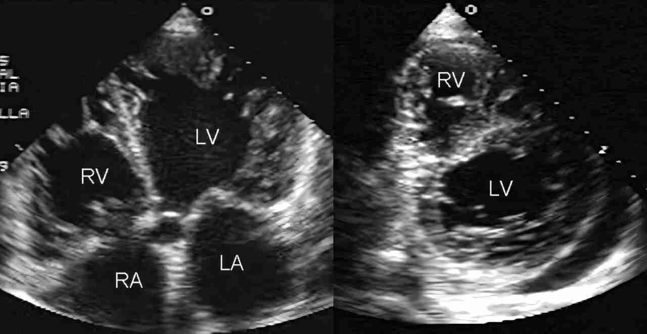 AI Program PanEcho Revolutionizes Echocardiogram