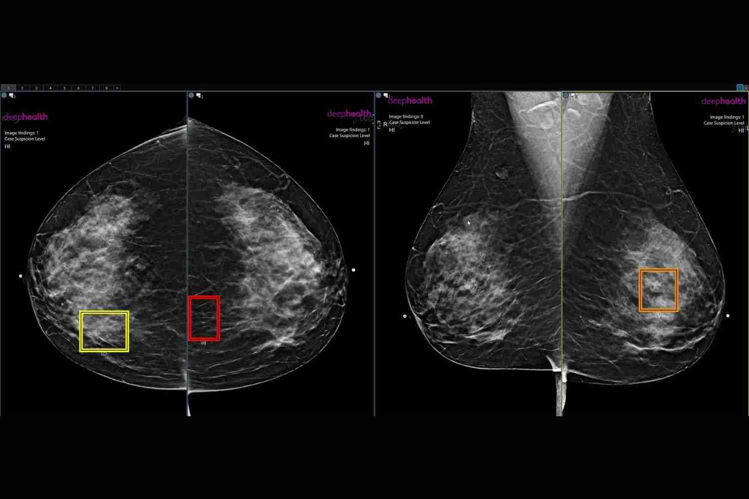 AI-Enhanced Mammography Shows Promise in Boosting Breast