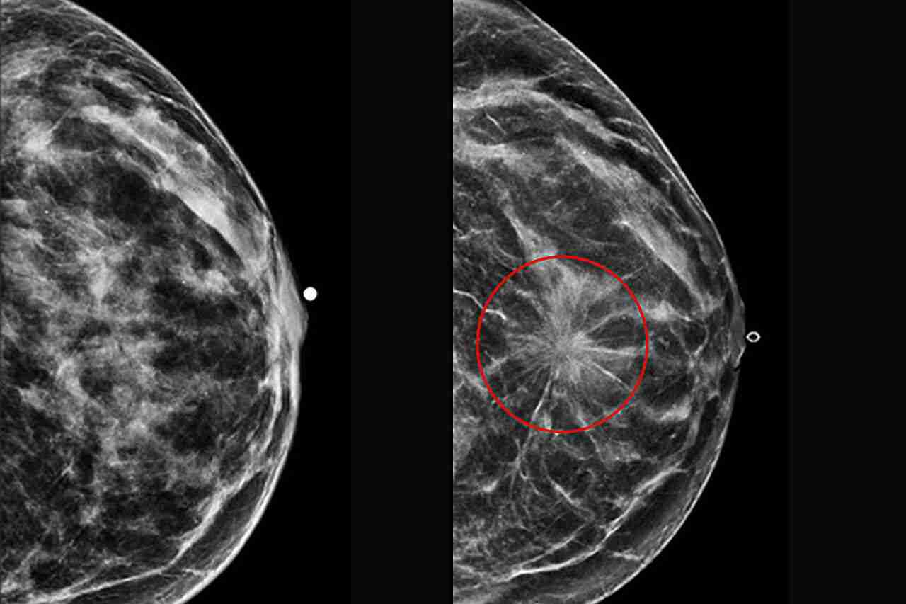 AI Enhances Mammography for Improved Breast Cancer Risk