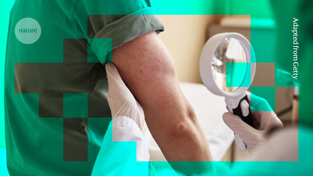 Google AI better than human doctors at diagnosing rashes