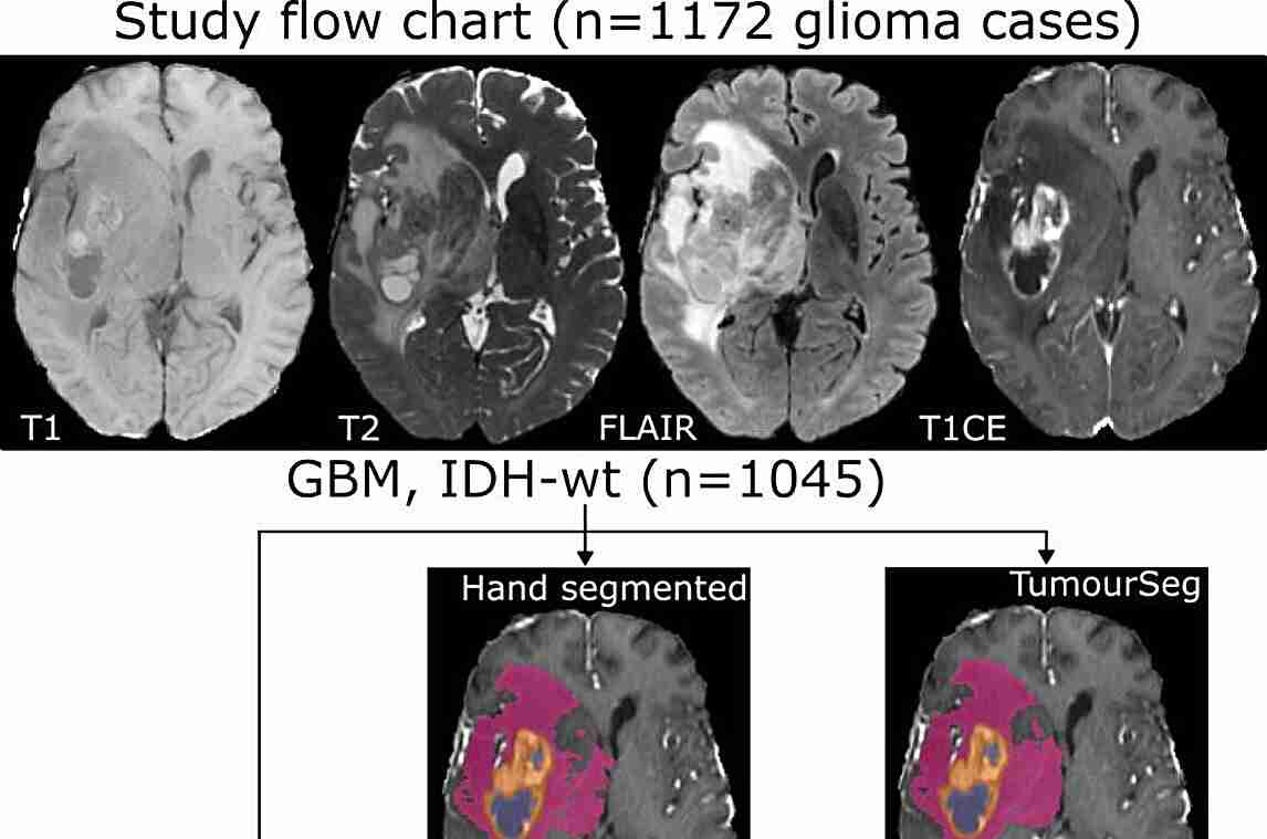 New AI tool could enhance and personalize brain tumor