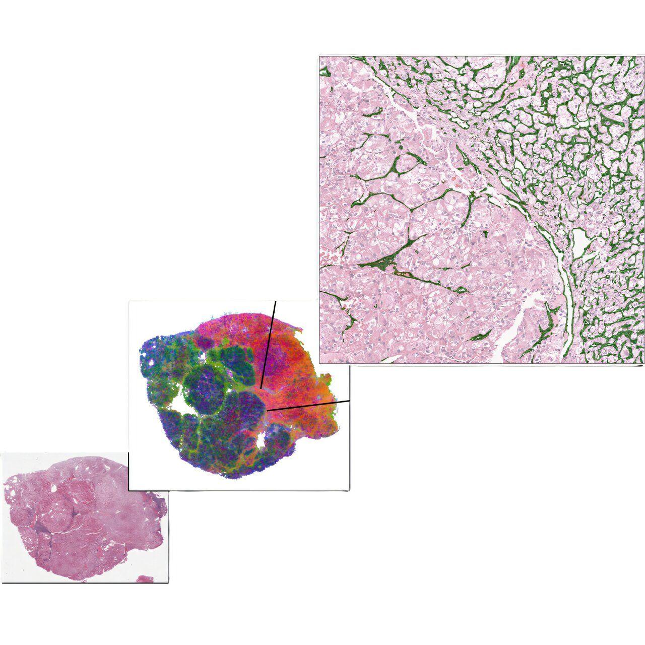 AI Model Predicts Kidney Cancer Therapy Response with High