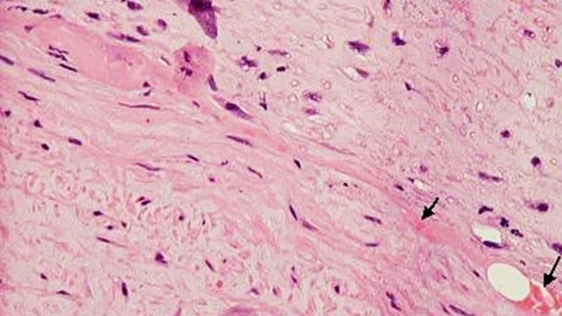 AI Revolutionizes Heart Disease Detection: From ECGs to