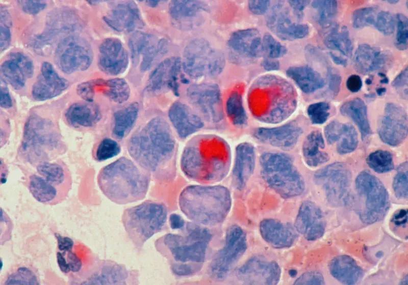 Google and Yale's AI Breakthrough: A New Frontier in Cancer