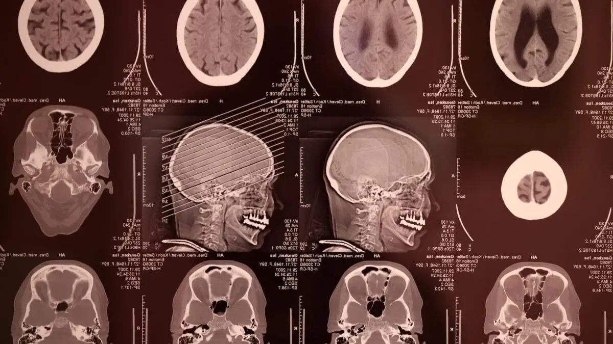 Meta AI unveils Brain2Qwerty v2 to decode brain activity