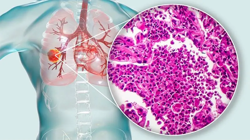 Source: Medscape