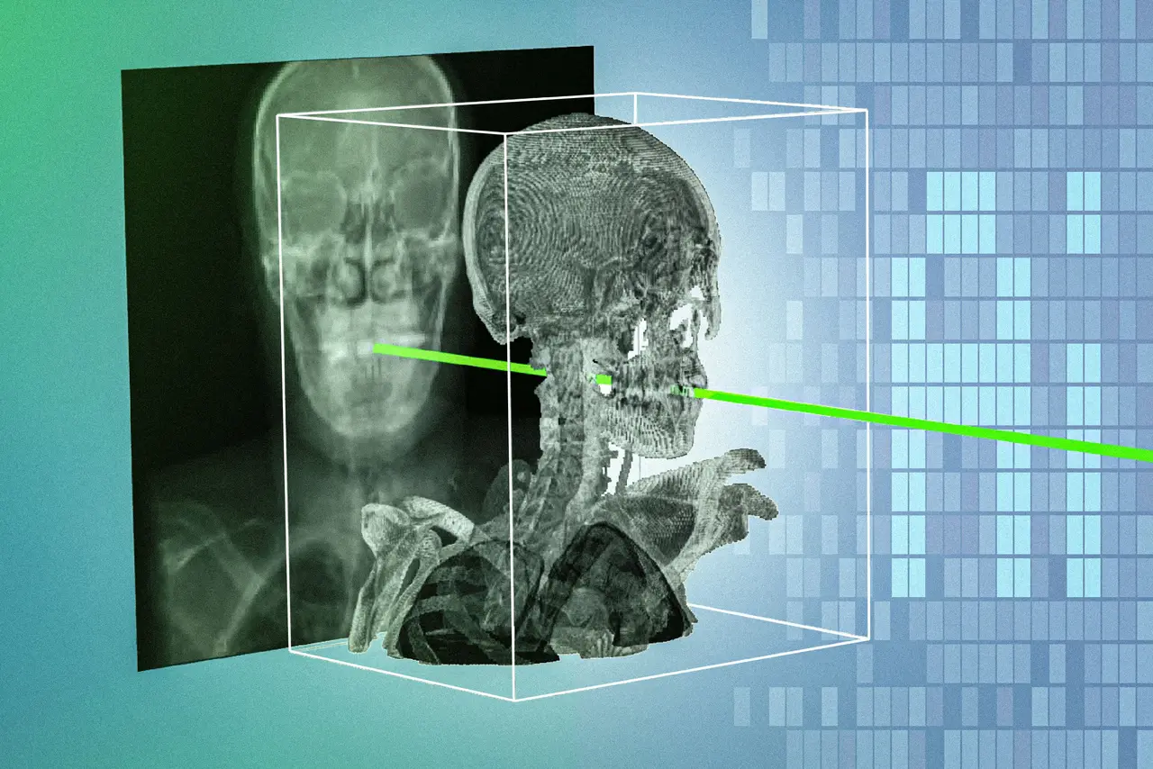 MIT Develops Patient-Specific AI Model That Achieves Sub-Millimeter Precision in Minimally Invasive Surgeries