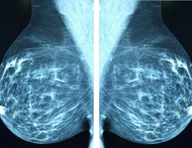 New AI System Weighs Uncertainty in Breast Cancer Diagnosis Using Deep Neural Networks
